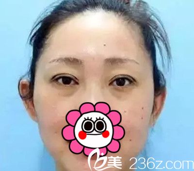 我在長春醫(yī)美找史迎軍院長做雙眼皮手術(shù)后恢復(fù)十天全過程