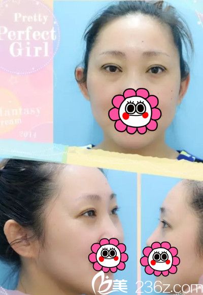 在長(zhǎng)春醫(yī)美做雙眼皮整形效果 在長(zhǎng)春醫(yī)美做雙眼皮整形效果