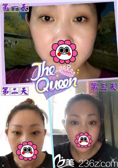 在長(zhǎng)春醫(yī)美做雙眼皮整形后1-3天恢復(fù) 在長(zhǎng)春醫(yī)美做雙眼皮整形后1-3天恢復(fù)