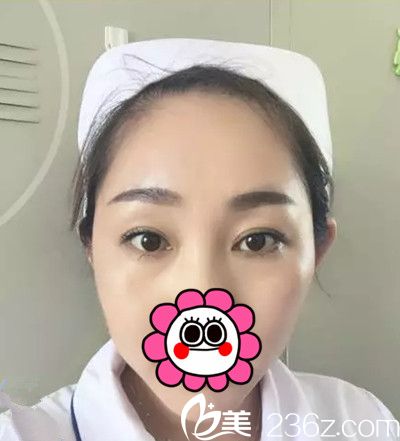 在長(zhǎng)春醫(yī)美做雙眼皮整形術(shù)后十天 在長(zhǎng)春醫(yī)美做雙眼皮整形術(shù)后十天