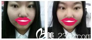 鄭州麗天做雙眼皮后12天