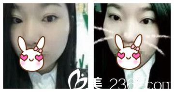 鄭州麗天雙眼皮后20天