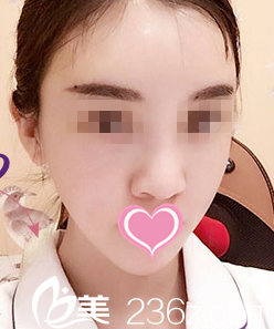 手術(shù)后第四天效果