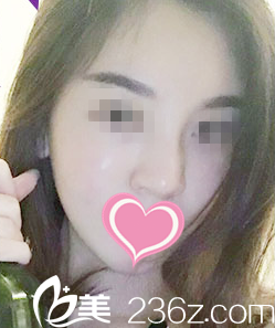 自體脂肪填充面部一周效果