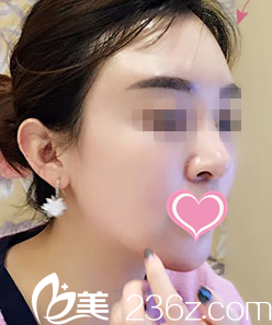 在大連艾加艾醫(yī)院做了面部自體脂肪填充后我把自己美美的嫁了出去！