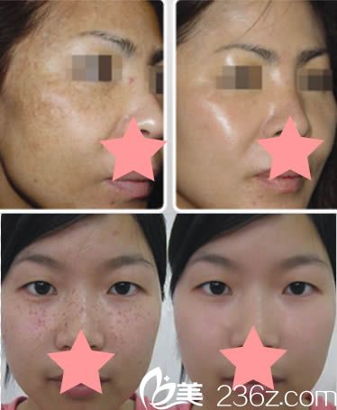 <!--<i data=20240703-sp></i>-->激光祛斑前后對比效果圖