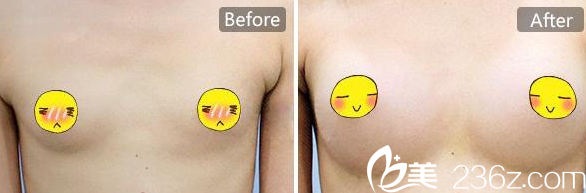 重慶好美整形楊東運(yùn)假體隆胸案例 重慶好美整形楊東運(yùn)假體隆胸案例