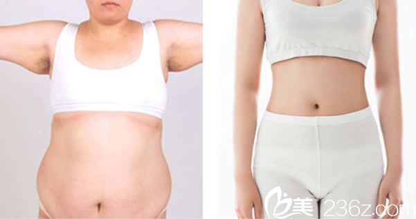 汝森腰腹部吸脂效果