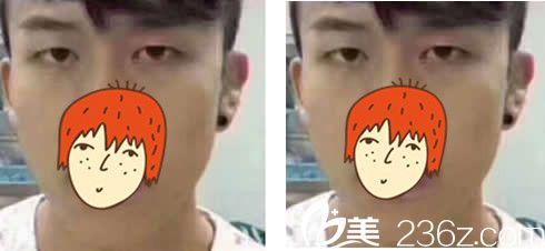 包頭汝森切開法雙眼皮前 包頭汝森切開法雙眼皮前