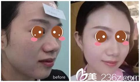 信陽(yáng)東方藝隆鼻整形