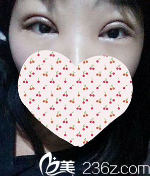 做完雙眼皮和開眼角第2天腫脹厲害 做完雙眼皮和開眼角第2天腫脹厲害