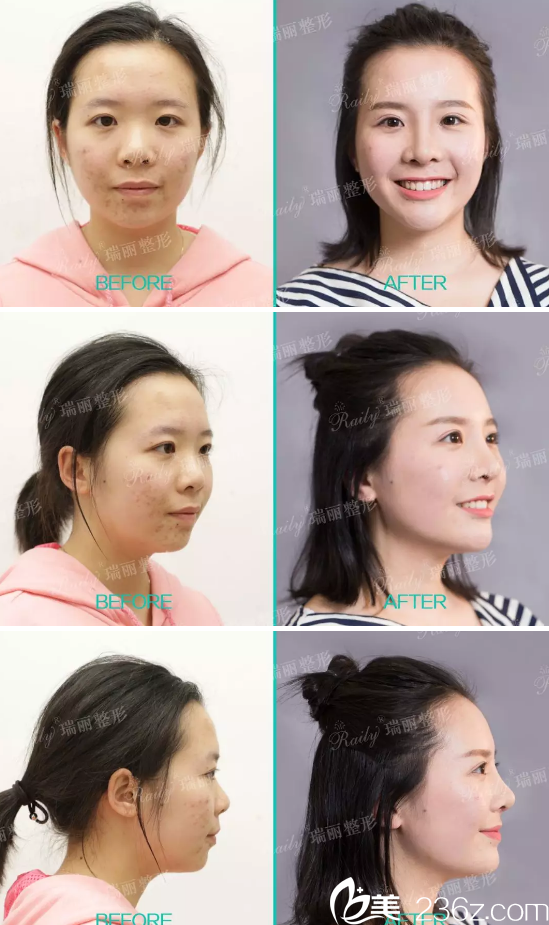 杭州瑞麗宋建良眼鼻綜合整形案例