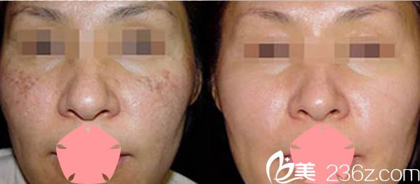 楊蓉婭激光祛斑前后對比案例