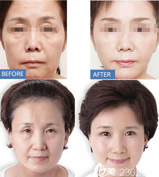張曉英醫(yī)生面部除皺前后對比案例