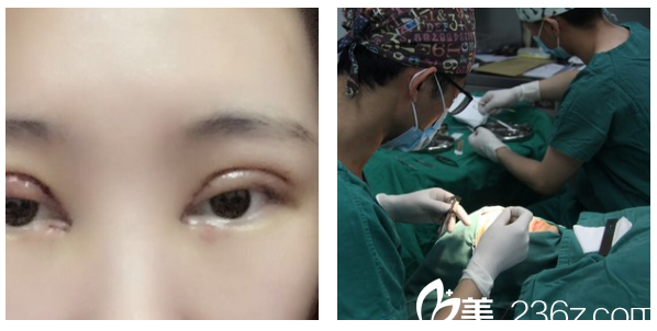 劉正源院長切開雙眼皮3天恢復(fù)情況 劉正源院長切開雙眼皮3天恢復(fù)情況