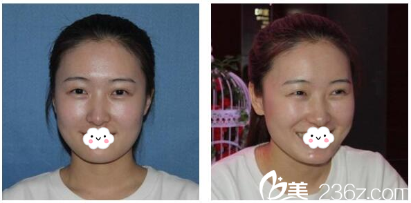 切開雙眼皮術(shù)前照片 切開雙眼皮術(shù)前照片