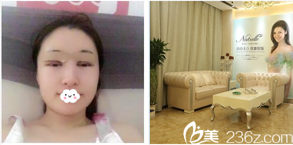 切開雙眼皮術(shù)后天自拍 切開雙眼皮術(shù)后天自拍