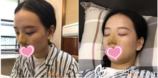 濰坊華美醫(yī)療美容醫(yī)院做的隆鼻手術(shù)當(dāng)天 濰坊華美醫(yī)療美容醫(yī)院做的隆鼻手術(shù)當(dāng)天