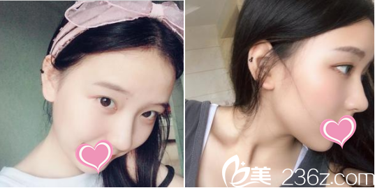 鼻子恢復(fù)到一個(gè)月的時(shí)候 鼻子恢復(fù)到一個(gè)月的時(shí)候