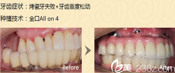 廈門華美王雪春醫(yī)生種植牙前后對比案例