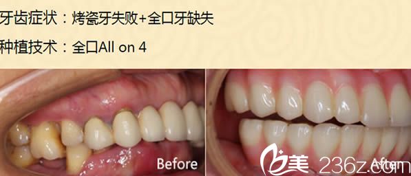 全口all on 4種植牙案例圖