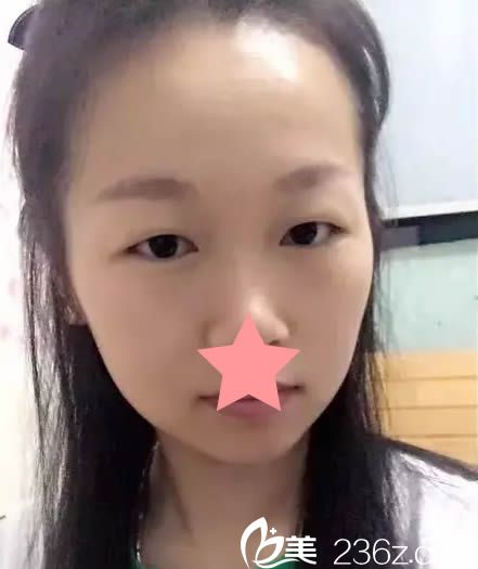 在廈門華美整形醫(yī)院做眼整形前的樣子 在廈門華美整形醫(yī)院做眼整形前的樣子