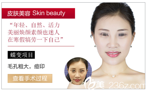 毛孔粗大痘印改善過程 毛孔粗大痘印改善過程