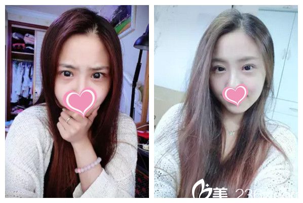 劉運濤主任做雙眼皮案例 劉運濤主任做雙眼皮案例