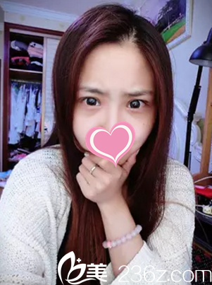 手術(shù)前是內(nèi)雙眼睛 手術(shù)前是內(nèi)雙眼睛