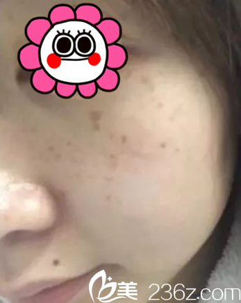 我去貴陽(yáng)美萊醫(yī)療美容醫(yī)院做激光祛斑 我去貴陽(yáng)美萊醫(yī)療美容醫(yī)院做激光祛斑