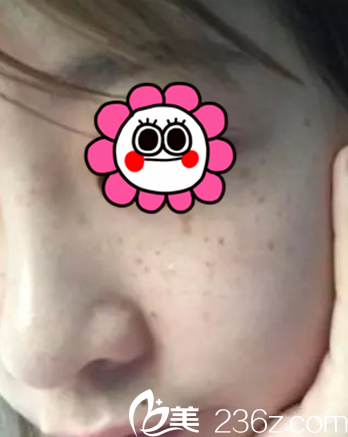 術(shù)前我臉上的斑 術(shù)前我臉上的斑