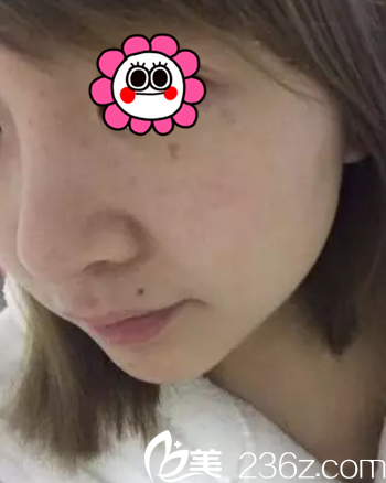 次做完感覺很多大斑點(diǎn)已經(jīng)不見了 次做完感覺很多大斑點(diǎn)已經(jīng)不見了