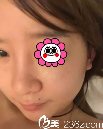 十天左右的效果 十天左右的效果