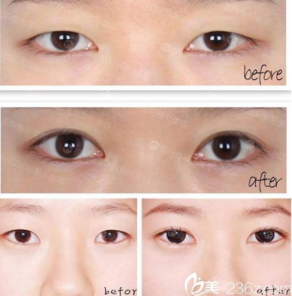 福州臺江雙眼皮前后對比案例