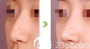 長春圣顏整形美容醫(yī)院隆鼻<span style= 長春圣顏整形美容醫(yī)院隆鼻<span style=