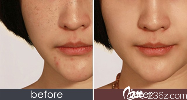 樸成哲院長激光祛斑效果 樸成哲院長激光祛斑效果