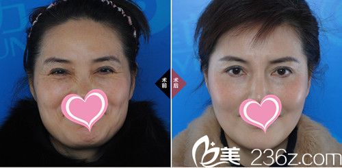 樸成哲院長除皺案例 樸成哲院長除皺案例