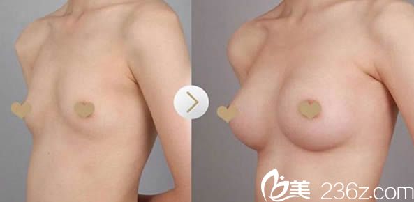 福州臺江鐘波假體隆胸案例圖 福州臺江鐘波假體隆胸案例圖