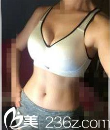 在哈爾濱藝星找洪潤基做自體脂肪隆胸，手感自然棒棒噠