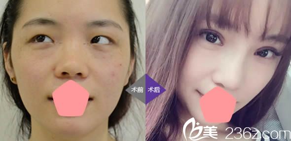 福州臺江馬美洲假體隆鼻和雙眼皮案例 福州臺江馬美洲假體隆鼻和雙眼皮案例