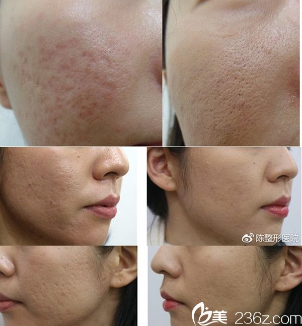 韓國(guó)陳整形外科醫(yī)院案例 韓國(guó)陳整形外科醫(yī)院案例