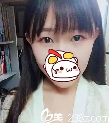 在長春圣顏做雙眼皮手術前 在長春圣顏做雙眼皮手術前