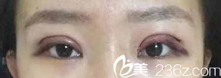 在長春圣顏做雙眼皮手術當天 在長春圣顏做雙眼皮手術當天