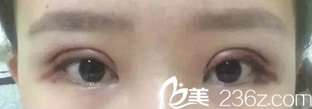 在長春圣顏做雙眼皮手術第二天 在長春圣顏做雙眼皮手術第二天