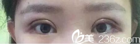 在長春圣顏做雙眼皮手術第三天 在長春圣顏做雙眼皮手術第三天