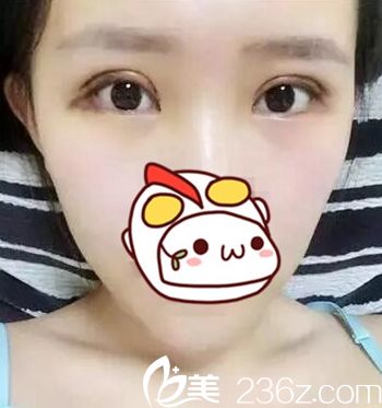 在長春圣顏做雙眼皮手術后4天 在長春圣顏做雙眼皮手術后4天