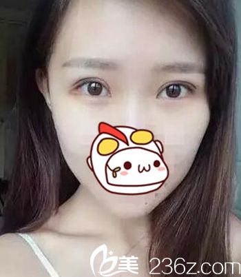 在長春圣顏做雙眼皮手術后5天 在長春圣顏做雙眼皮手術后5天