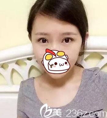 在長春圣顏做雙眼皮手術后11天 在長春圣顏做雙眼皮手術后11天