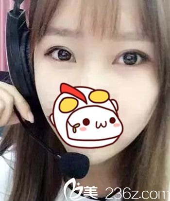 在長春圣顏做雙眼皮手術后40天 在長春圣顏做雙眼皮手術后40天