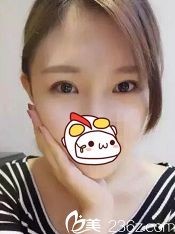 在長春圣顏找白秉憲花9980元做雙眼皮手術(shù)后 擁有電眼